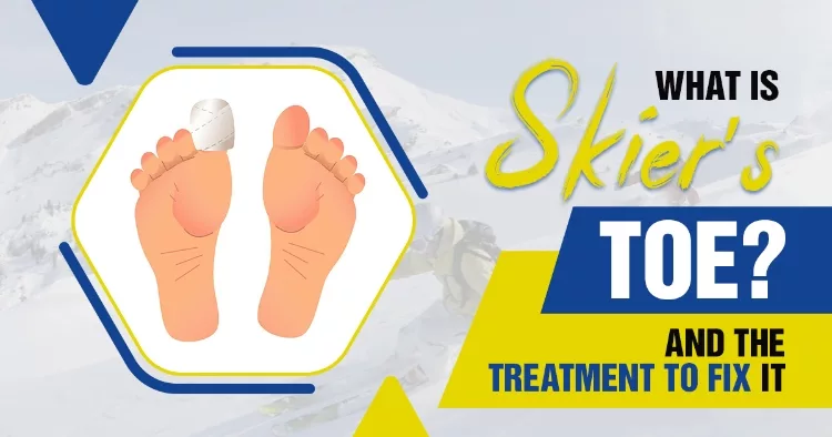 What Is Skier’s Toe? And The Treatment To Fix It