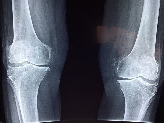 X Ray From Skiing With Bad Knees